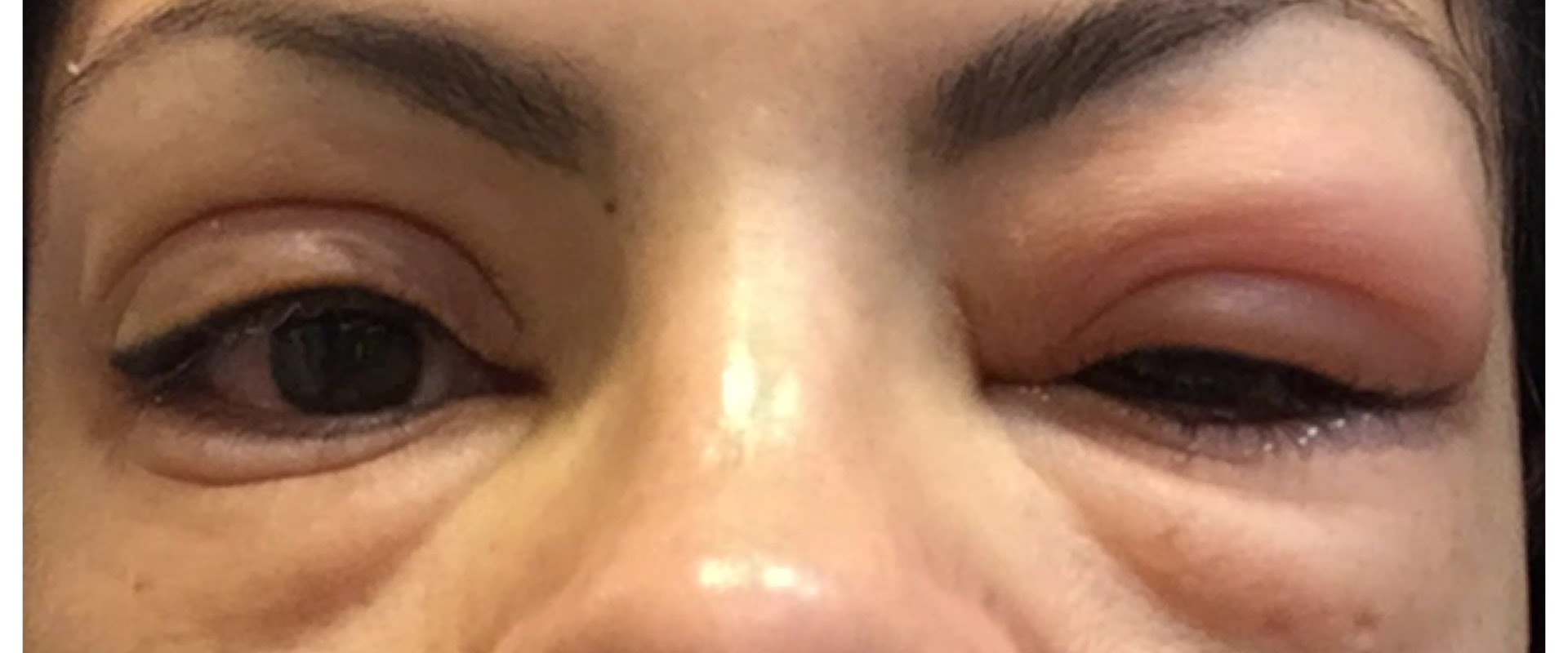 The Dangers of Eyelash Glue: What You Need to Know