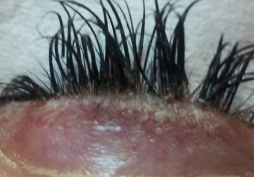How to Regrow Eyelashes After Extensions